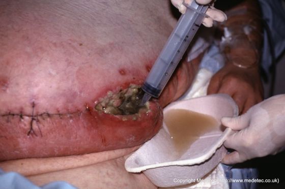 Infected Abdominal Wound